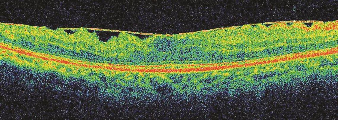 Multicolored Optical Coherence Tomography imaging study result