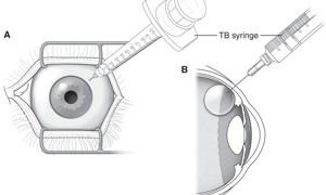 Illustration demonstrating needle injection for intraocular injection therapy