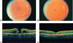 Image studies showing a macular hole