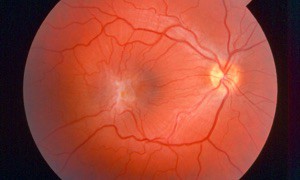Image of retina showing macular pucker