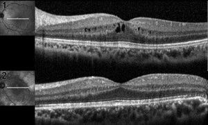 Optical Coherence Tomography image study result