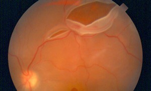 Image retina showing a retinal tear
